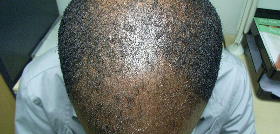 Risk of Prostate Cancer? Check Your Hair Pattern